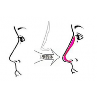 注射隆鼻和硅胶假体隆鼻哪个好_假体隆鼻是不是永久效果